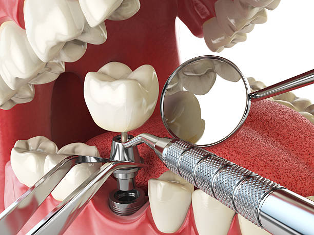 Best Emergency Tooth Extraction in Lochearn, MD